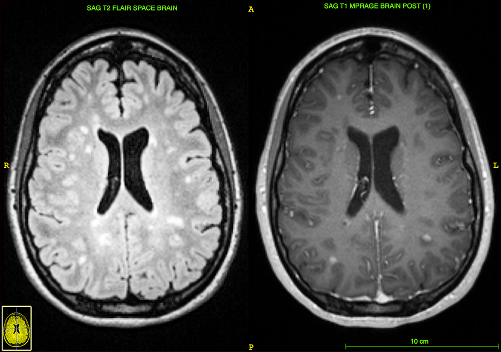 Image of the brain demonstrating gadolinium-enhancing lesions typical of MS